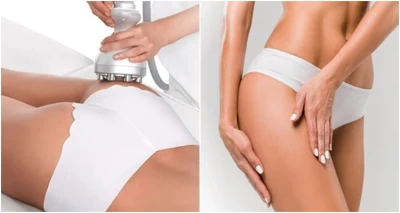 44 UDARNA tretmana mršavljenja za samo 250 eura!