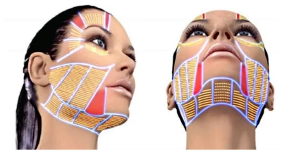 Hifu Ultraformer 7D lifting lica, vrata i dekoltea nove generacije!