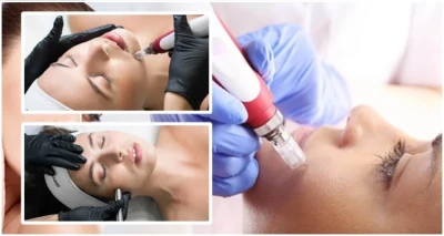 Microneedling uz uzv čišćenje / mikrodermoabraziju ili mikrodermoabraziju i kisik + GRATIS hladni čekić!