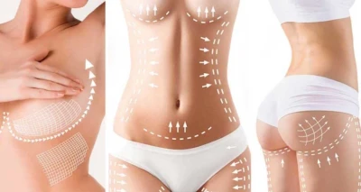 Najnoviji hladni HIFU - kombinacija hladnog HIFU-a i Liposonics tehnologije omogućuje ciljano djelovanje na masne stanice i opuštenu kožu!