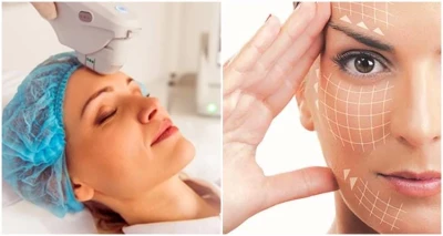 Nova neinvazivna tehnologija faceliftinga - HIFU V MAX tretman kojim se postižu nevjerojatni rezultati u samo jednom dolasku!