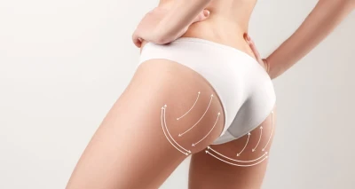 15 tretmana kavitacije, presoterapije i maderoperapije!