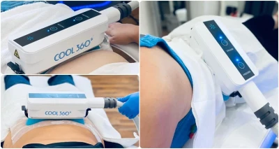 [RIJEKA] 1 tretman 3D Kriolipoliza 30min - Zamrzni masne stanice i smanji obujam!