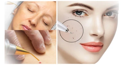 [RIJEKA-KORZO] Uklanjanje bradavice, keratoze ili fibroma inovativnim tretmanom PLASMA PEN - najefikasniji način uklanjanja bradavica!