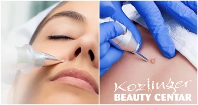 Uklanjanje bradavice, keratoze ili fibroma inovativnim tretmanom PLASMA PEN - najefikasniji način uklanjanja bradavica!