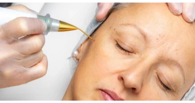 Uklanjanje kapilara s lica elektrokoagulacijom