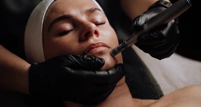 Frakcijski microneedling s RF (RF Microneedling) cijelog lica, vrata i dekoltea!