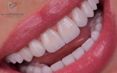 Za neodoljivo lijep osmijeh i blistavo bijele zube posjetite Stomatološku ordinaciju Dr. Kurtanović Dental Clinic!