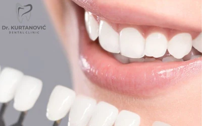 Sjajni osmjesi počinju ovdje I Istražite učinkovite mogućnosti izbjeljivanja zuba u Stomatološkoj ordinaciji Dr. Kurtanović Dental Clinic!